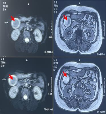 Complete remission of gallbladder neuroendocrine carcinoma with liver metastasis by tislelizumab plus chemotherapy: a case report